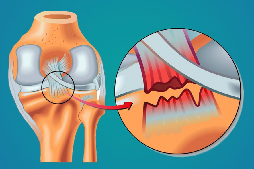 Ruptura do ligamento cruzado posterior